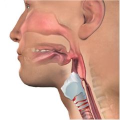 Current Research Related to Mechanical Ventilation and Speaking Valve Use Doctor adjusting patient's trach